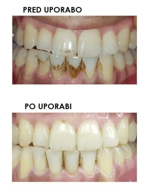 Silkn ToothWave TW1PE3001 Advanced Dental Care Device